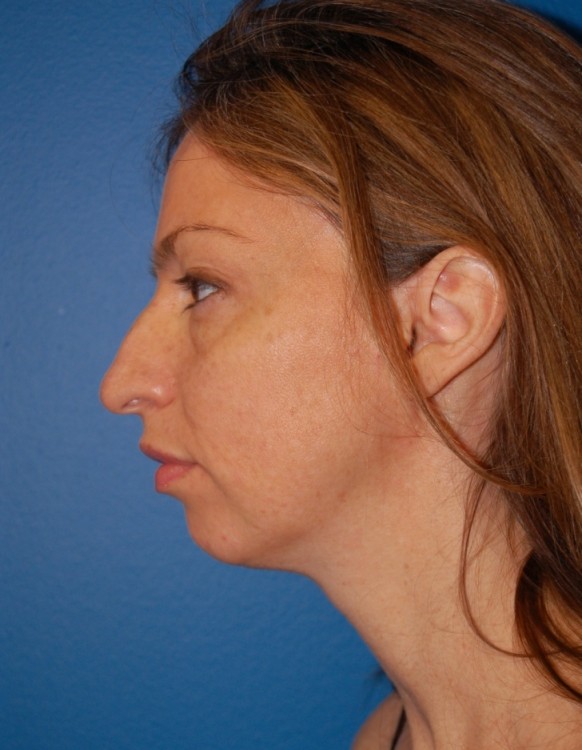 Another before picture for Case 1 Profile Balancing (Chin & Rhinoplasty) Before and After Photos