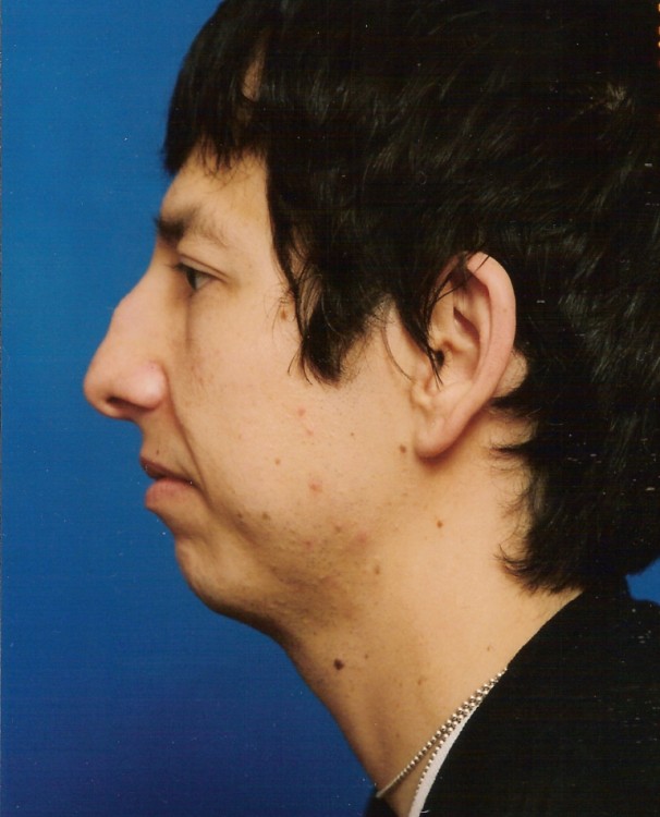 Another before picture for Case 2 Profile Balancing (Chin & Rhinoplasty) Before and After Photos