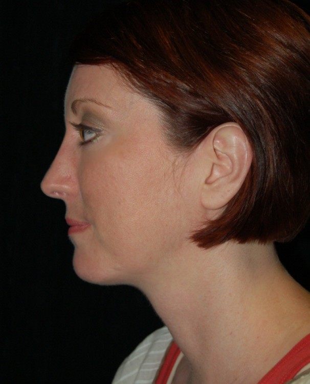 Another after picture for Case 3 Profile Balancing (Chin & Rhinoplasty) Before and After Photos