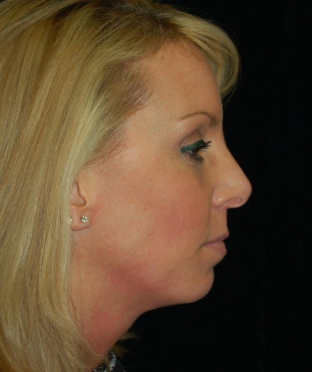 Another before picture for Case 6 Profile Balancing (Chin & Rhinoplasty) Before and After Photos