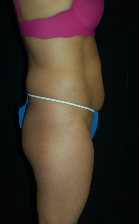 Before thumbnail for Case 17 Liposuction Before and After Photos