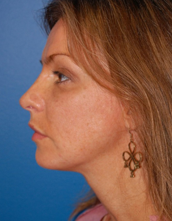 Another after picture for Case 1 Profile Balancing (Chin & Rhinoplasty) Before and After Photos