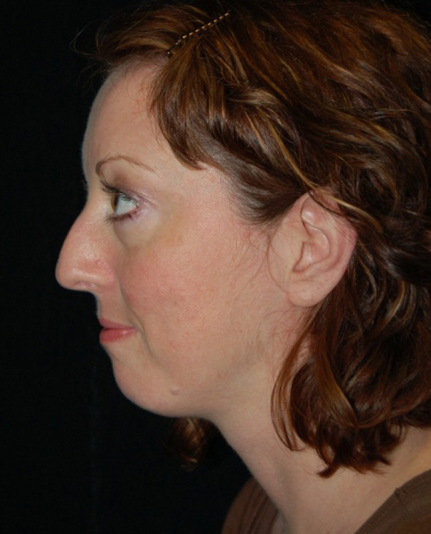 Another before picture for Case 3 Profile Balancing (Chin & Rhinoplasty) Before and After Photos