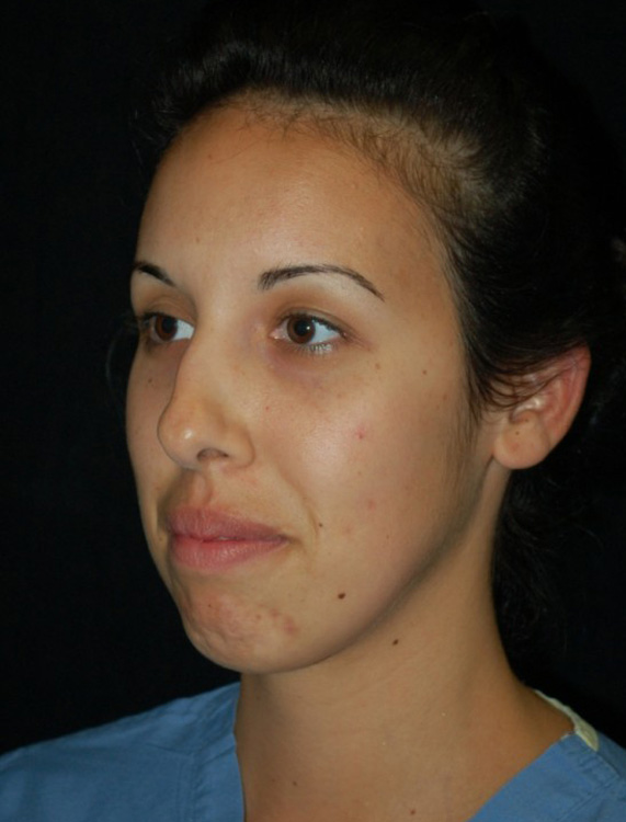 Another before picture for Case 4 Profile Balancing (Chin & Rhinoplasty) Before and After Photos